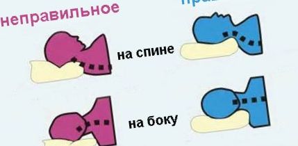 Ortopéd párnák, hogyan válasszuk ki a megfelelő opciót Fejhelyzet a párnán